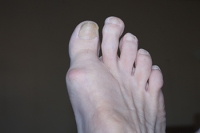 Morton’s Toe Can Lead To Ongoing Foot Pain