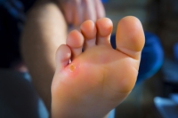 Corns and Calluses on the Feet