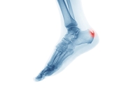 Common Reasons Heel Spurs Develop